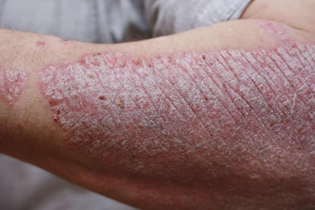 Arm with eczema, highlighting skin conditions linked to microbiome imbalances and the need for supportive skincare.