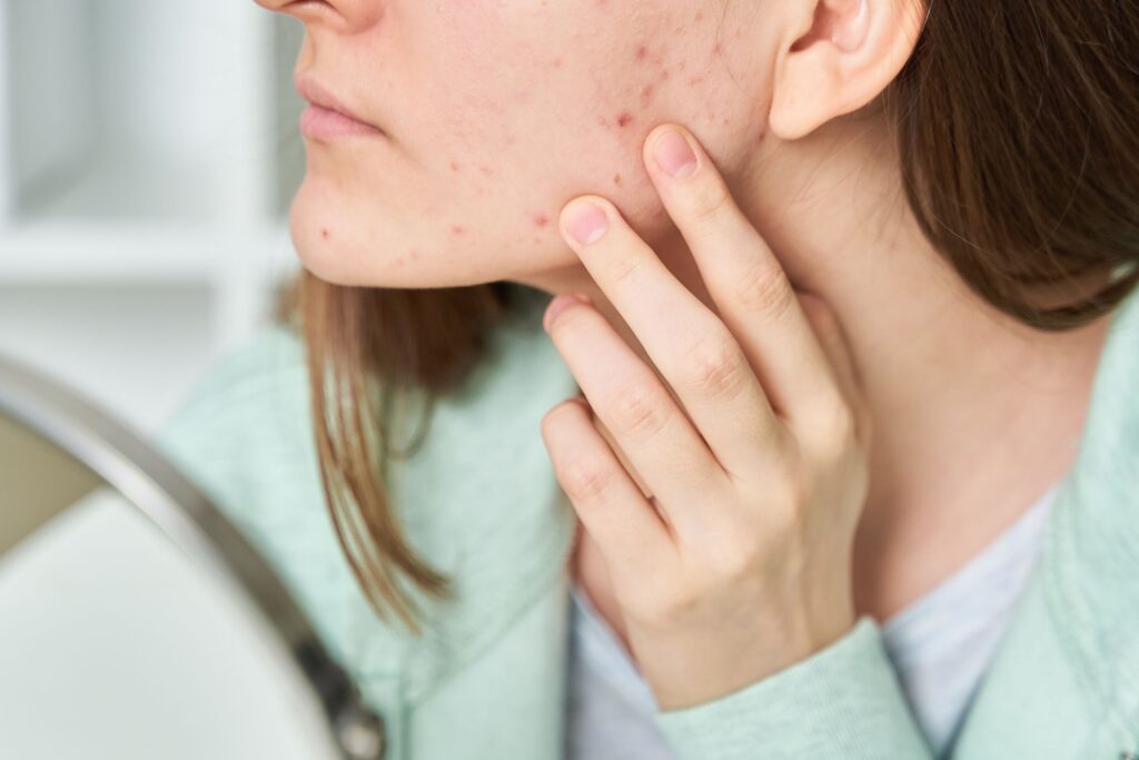 Close-up of a face with acne, illustrating the challenges of maintaining a balanced skin microbiome for clear skin.