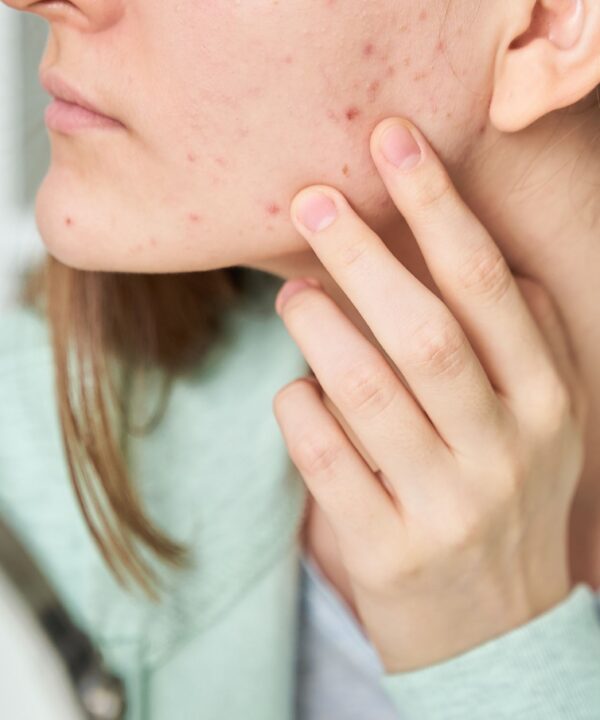 Close-up of a face with acne, illustrating the challenges of maintaining a balanced skin microbiome for clear skin.